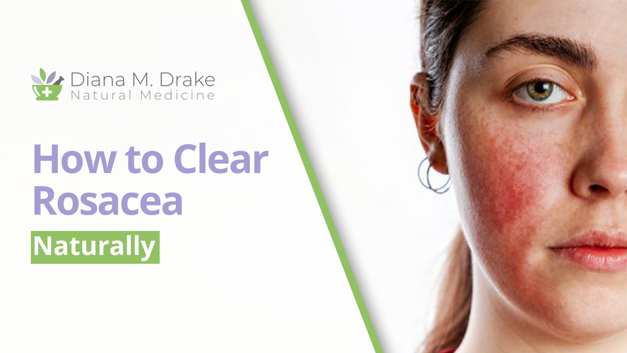
    How to Clear Rosacea Naturally
